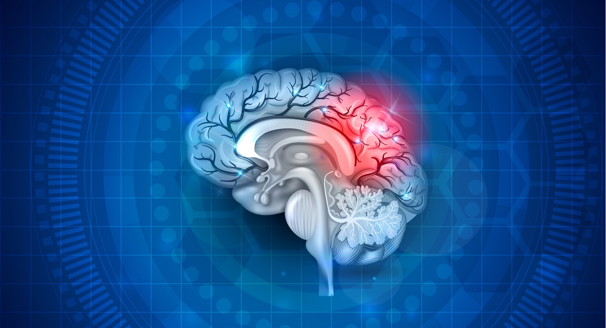 AVC (Acidente Vascular Cerebral)